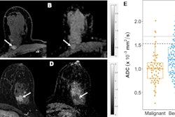 Apparent diffusion coefficient (ADC) measurements for benign and malignant BI-RADS category 4 or 5 lesions at MRI. (A, B) Benign BI-RADS category 4 lesion in a 55-year-old woman. (A) Dynamic contrast-enhanced MRI (DCE-MRI) scan shows a 12-mm, oval, circumscribed, homogeneous mass in the right posterior breast (arrow). (B) On the diffusion-weighted image, the lesion shows high diffusivity (arrow), with an ADC of 2.04 × 10-3 mm2/sec. Biopsy revealed benign fibroadenoma. (C, D) Malignant BI-RADS category 4 lesion in a 41-year-old woman. (C) DCE-MRI scan shows a 24-mm irregular, heterogeneous mass at the 3 o’clock position in the left breast (arrow). (D) On the diffusion-weighted image, the lesion demonstrates low diffusivity (arrow), with an ADC of 0.91 × 10-3 mm2/sec. Biopsy revealed invasive ductal carcinoma. All MRI scans are shown in the axial plane. (E) Box plot shows ADC measurements for 240 BI-RADS 4 and 5 lesions (63 malignant and 177 benign). Both prespecified optimal and conservative ADC cutoffs are indicated on the plot for reference: 1.53 × 10-3 mm2/sec (dashed line) and 1.68 × 10-3 mm2/sec (dotted line), respectively. All ADCs were calculated with maximum b value of 800 sec/mm2. The midline of each box shows the median value, and the box extends from first to third quartiles. The whiskers extend from the first and third quartiles to the smallest and largest values, respectively, if those values are within 1.5 times the IQR. If not, the length of the whiskers is limited to 1.5 times the IQR. Image courtesy of the RSNA.