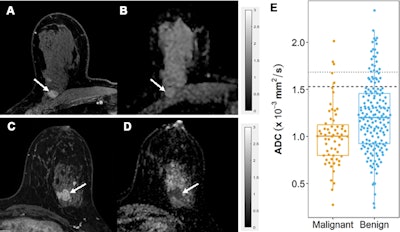 Apparent diffusion coefficient (ADC) measurements for benign and malignant BI-RADS category 4 or 5 lesions at MRI. (A, B) Benign BI-RADS category 4 lesion in a 55-year-old woman. (A) Dynamic contrast-enhanced MRI (DCE-MRI) scan shows a 12-mm, oval, circumscribed, homogeneous mass in the right posterior breast (arrow). (B) On the diffusion-weighted image, the lesion shows high diffusivity (arrow), with an ADC of 2.04 × 10-3 mm2/sec. Biopsy revealed benign fibroadenoma. (C, D) Malignant BI-RADS category 4 lesion in a 41-year-old woman. (C) DCE-MRI scan shows a 24-mm irregular, heterogeneous mass at the 3 o’clock position in the left breast (arrow). (D) On the diffusion-weighted image, the lesion demonstrates low diffusivity (arrow), with an ADC of 0.91 × 10-3 mm2/sec. Biopsy revealed invasive ductal carcinoma. All MRI scans are shown in the axial plane. (E) Box plot shows ADC measurements for 240 BI-RADS 4 and 5 lesions (63 malignant and 177 benign). Both prespecified optimal and conservative ADC cutoffs are indicated on the plot for reference: 1.53 × 10-3 mm2/sec (dashed line) and 1.68 × 10-3 mm2/sec (dotted line), respectively. All ADCs were calculated with maximum b value of 800 sec/mm2. The midline of each box shows the median value, and the box extends from first to third quartiles. The whiskers extend from the first and third quartiles to the smallest and largest values, respectively, if those values are within 1.5 times the IQR. If not, the length of the whiskers is limited to 1.5 times the IQR. Image courtesy of the RSNA.