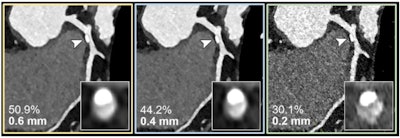 Coronary CT angiography in case of suspected progression of known coronary artery disease in a 56-year-old female patient. Curved multiplanar reconstructions with cross-sectional thicknesses of 0.6 mm (yellow outline), 0.4 mm (blue outline), and 0.2 mm (green outline) show calcified plaque (arrow) and coronary artery stenosis (inset image), respectively. is shown. As the section thickness decreases, there will be less calcium bloom and therefore the assessment of the percentage of coronary artery stenosis in this patient will be less demanding. Images and captions courtesy of RSNA.
