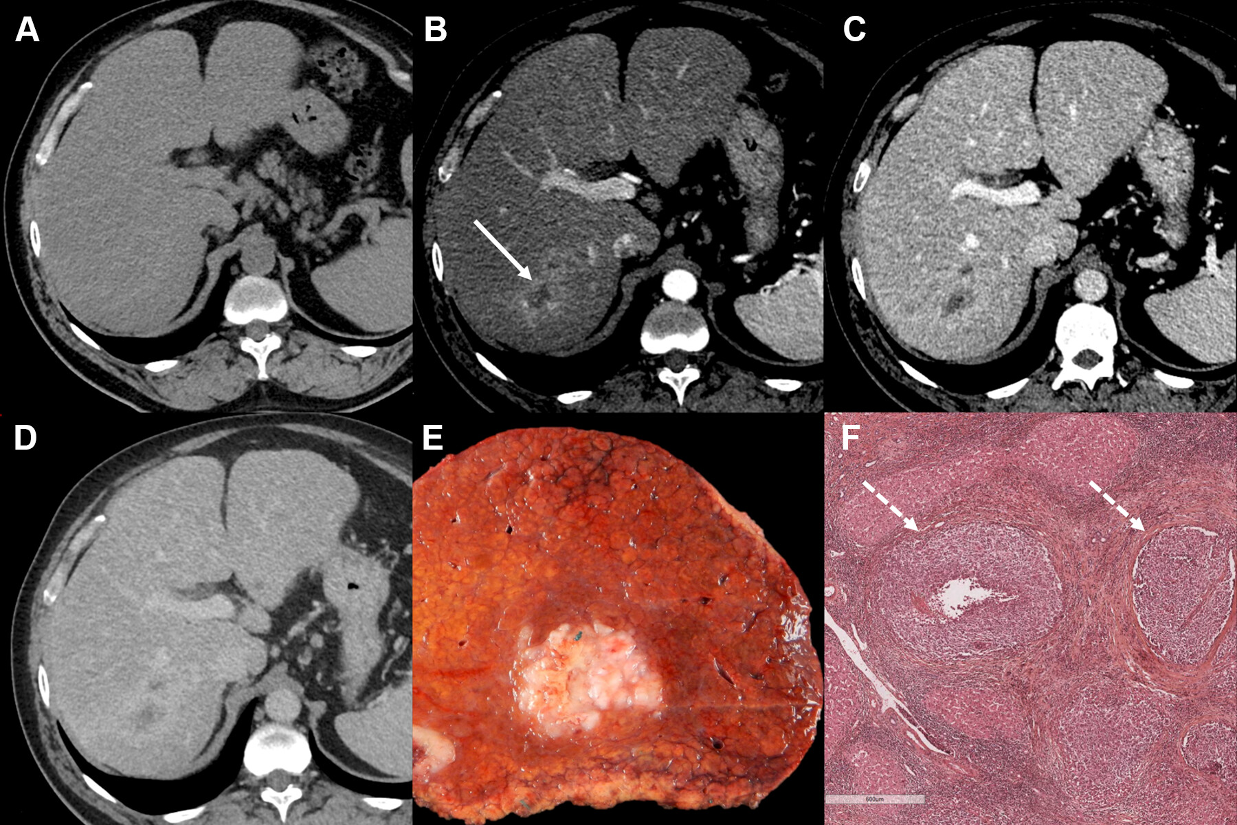 Images in a 55-year-old male patient with a history of hepatitis C virus-related cirrhosis and a 45-mm hepatocellular carcinoma (HCC). Axial (A) precontrast and (B-D) contrast-enhanced CT images in the (B) hepatic arterial, (C) portal venous, and (D) delayed phases show lesion (arrow in B) with rim arterial phase hyperenhancement categorized as LI-RADS category LR-M. (E) Photograph of resected specimen shows a poorly demarcated HCC. (F) Photomicrograph (hematoxylin-eosin stain) reveals a poorly differentiated HCC with microvascular invasion (arrows). Scale bar in F = 600 &micro;m. Intrahepatic recurrence was observed at 14 months after resection. Image courtesy of the RSNA.