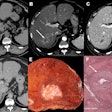 Images in a 55-year-old male patient with a history of hepatitis C virus-related cirrhosis and a 45-mm hepatocellular carcinoma (HCC). Axial (A) precontrast and (B-D) contrast-enhanced CT images in the (B) hepatic arterial, (C) portal venous, and (D) delayed phases show lesion (arrow in B) with rim arterial phase hyperenhancement categorized as LI-RADS category LR-M. (E) Photograph of resected specimen shows a poorly demarcated HCC. (F) Photomicrograph (hematoxylin-eosin stain) reveals a poorly differentiated HCC with microvascular invasion (arrows). Scale bar in F = 600 µm. Intrahepatic recurrence was observed at 14 months after resection. Image courtesy of the RSNA.