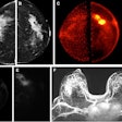 Images obtained in a 50-year-old female patient with a new biopsy-proven malignant lesion in the left breast. (A) Craniocaudal mammogram of the right breast does not show any lesion. (B) The malignant lesion corresponds with a 7-cm irregular and spiculated mass on the left craniocaudal mammogram. Ultrasound-guided core-needle biopsy revealed grade 2 invasive lobular carcinoma. (C) The bilateral positron emission mammographic craniocaudal color image obtained one hour after intravenous injection of 185 MBq of F-18-labeled fluorodeoxyglucose (F-18 FDG) shows a mass with intense uptake in the left breast with known cancer and no abnormal uptake in the right breast. Positron emission mammographic craniocaudal images of the left breast obtained (D) one hour and (E) four hours after intravenous injection of 185 MBq of F-18 FDG show no substantial visual difference in uptake of the known cancer. (F) Axial contrast-enhanced fat-saturated subtracted T1-weighted MR image with maximum intensity projection reconstruction obtained 90 seconds after intravenous injection of 0.1 mmol of gadolinium-based contrast material per kilogram of body weight also shows the enhancing mass corresponding to known malignancy (arrow) and marked bilateral background parenchymal enhancement, with multiple nonspecific foci of enhancement in the contralateral breast. The patient opted for bilateral mastectomy, which confirmed left-sided malignancy and no malignancy in the contralateral breast. Image courtesy of the RSNA,