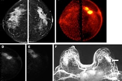 Images obtained in a 50-year-old female patient with a new biopsy-proven malignant lesion in the left breast. (A) Craniocaudal mammogram of the right breast does not show any lesion. (B) The malignant lesion corresponds with a 7-cm irregular and spiculated mass on the left craniocaudal mammogram. Ultrasound-guided core-needle biopsy revealed grade 2 invasive lobular carcinoma. (C) The bilateral positron emission mammographic craniocaudal color image obtained one hour after intravenous injection of 185 MBq of F-18-labeled fluorodeoxyglucose (F-18 FDG) shows a mass with intense uptake in the left breast with known cancer and no abnormal uptake in the right breast. Positron emission mammographic craniocaudal images of the left breast obtained (D) one hour and (E) four hours after intravenous injection of 185 MBq of F-18 FDG show no substantial visual difference in uptake of the known cancer. (F) Axial contrast-enhanced fat-saturated subtracted T1-weighted MR image with maximum intensity projection reconstruction obtained 90 seconds after intravenous injection of 0.1 mmol of gadolinium-based contrast material per kilogram of body weight also shows the enhancing mass corresponding to known malignancy (arrow) and marked bilateral background parenchymal enhancement, with multiple nonspecific foci of enhancement in the contralateral breast. The patient opted for bilateral mastectomy, which confirmed left-sided malignancy and no malignancy in the contralateral breast. Image courtesy of the RSNA,