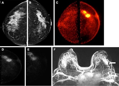 Images obtained in a 50-year-old female patient with a new biopsy-proven malignant lesion in the left breast. (A) Craniocaudal mammogram of the right breast does not show any lesion. (B) The malignant lesion corresponds with a 7-cm irregular and spiculated mass on the left craniocaudal mammogram. Ultrasound-guided core-needle biopsy revealed grade 2 invasive lobular carcinoma. (C) The bilateral positron emission mammographic craniocaudal color image obtained one hour after intravenous injection of 185 MBq of F-18-labeled fluorodeoxyglucose (F-18 FDG) shows a mass with intense uptake in the left breast with known cancer and no abnormal uptake in the right breast. Positron emission mammographic craniocaudal images of the left breast obtained (D) one hour and (E) four hours after intravenous injection of 185 MBq of F-18 FDG show no substantial visual difference in uptake of the known cancer. (F) Axial contrast-enhanced fat-saturated subtracted T1-weighted MR image with maximum intensity projection reconstruction obtained 90 seconds after intravenous injection of 0.1 mmol of gadolinium-based contrast material per kilogram of body weight also shows the enhancing mass corresponding to known malignancy (arrow) and marked bilateral background parenchymal enhancement, with multiple nonspecific foci of enhancement in the contralateral breast. The patient opted for bilateral mastectomy, which confirmed left-sided malignancy and no malignancy in the contralateral breast. Image courtesy of the RSNA,