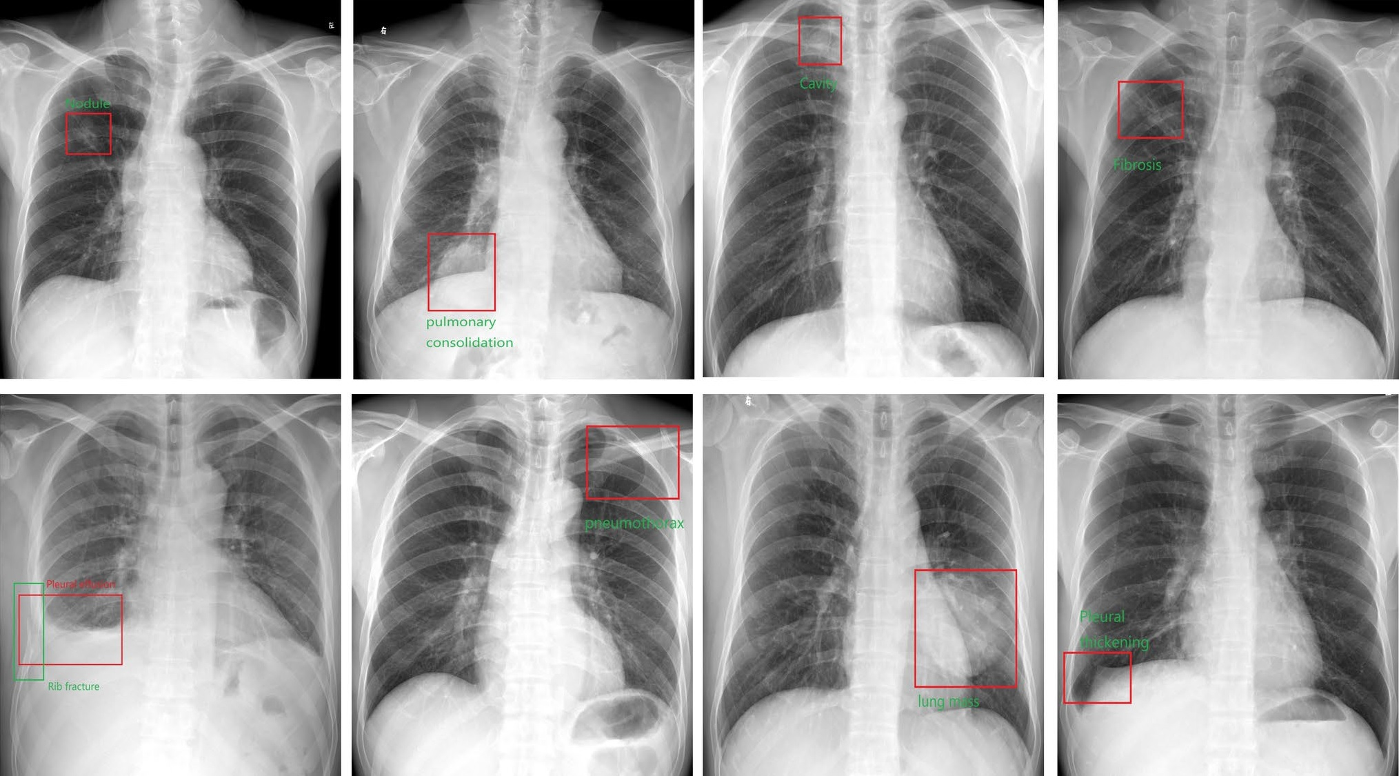 The AI system output the bounding boxes and labels of the lesions to assist radiologists. Image courtesy of the Journal of Imaging Informatics in Medicine.
