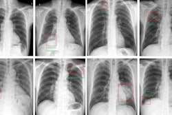 The AI system output the bounding boxes and labels of the lesions to assist radiologists. Image courtesy of the Journal of Imaging Informatics in Medicine.