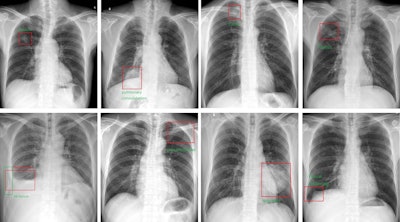 The AI system output the bounding boxes and labels of the lesions to assist radiologists. Image courtesy of the Journal of Imaging Informatics in Medicine.