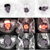Representative example of tumor segmentation of radiomics regions of interest (ROI) on axial, coronal, and sagittal PET/CT imaging.