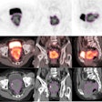 Representative example of tumor segmentation of radiomics regions of interest (ROI) on axial, coronal, and sagittal PET/CT imaging.