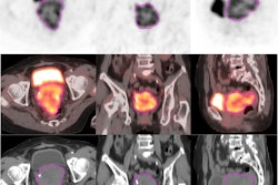 Representative example of tumor segmentation of radiomics regions of interest (ROI) on axial, coronal, and sagittal PET/CT imaging.