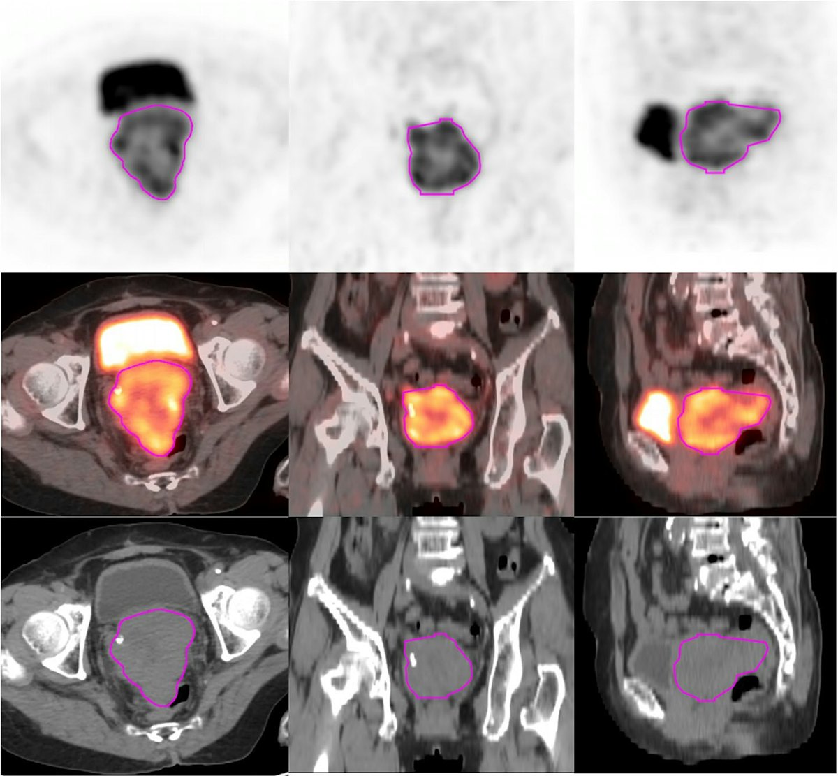 PET/CT radiomics predicts outcomes in women with cervical cancer ...