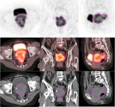 Representative example of tumor segmentation of radiomics regions of interest (ROI) on axial, coronal, and sagittal PET/CT imaging.