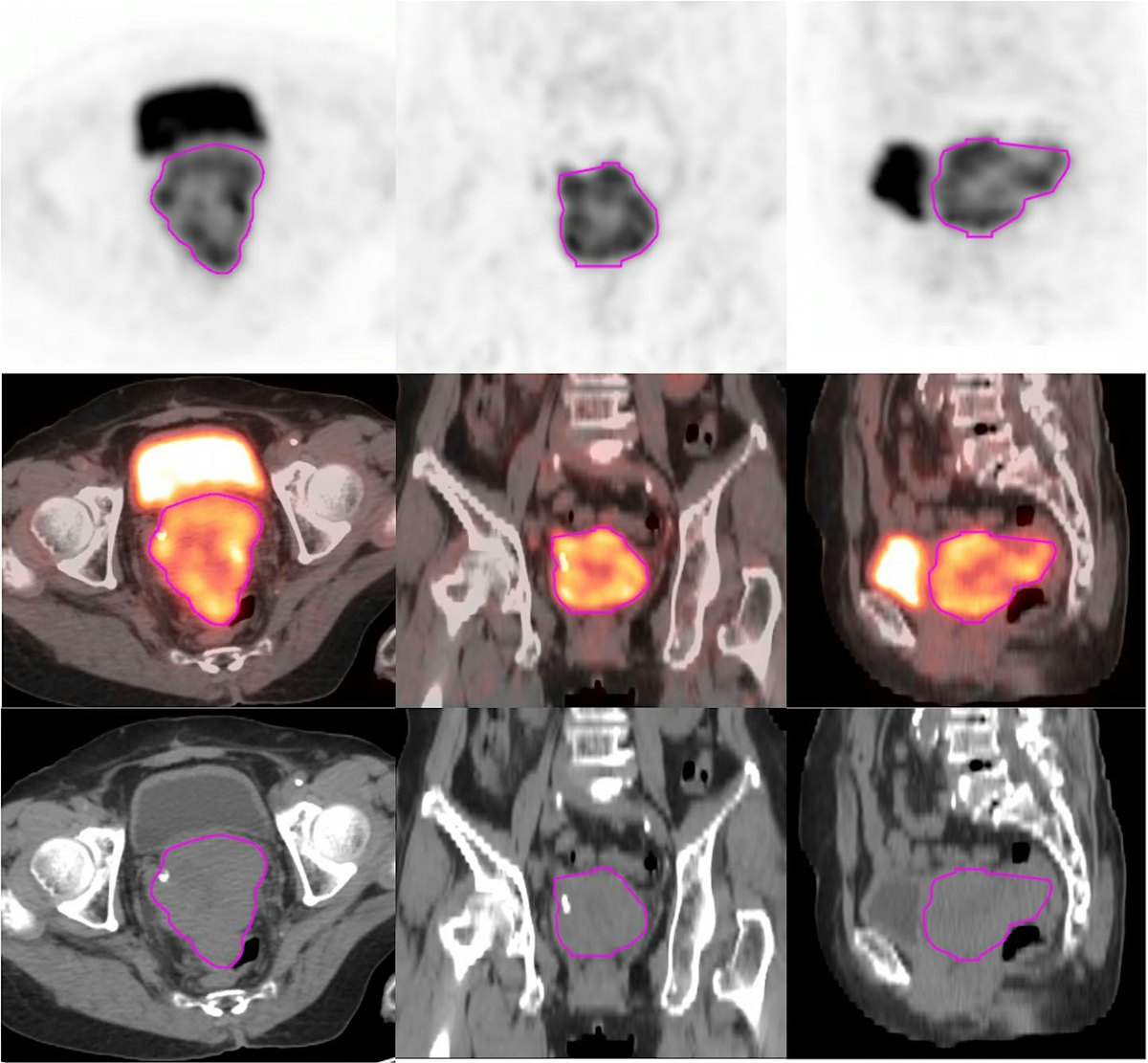 PET/CT 스캔으로 자궁경부암 여성의 결과 예측
