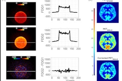 Data analysis validation. Panel A: Image and line profile through the bottle on scans 1 (top) and 2 (middle), and the difference image (bottom) calculated according to Equation 3. Panel B: Data from a representative participant showing the effect of the dose correction on the PETWALK image using Equation 1 when applied to co-registered images in native subject space. The images were then warped to standard Montreal Neurological Institute (MNI) space Top: PETSTAND, middle – uncorrected PETWALK, bottom – corrected PETWALK. The color bar shows image intensity across the three images. Image courtesy of NeuroImage.