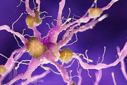 Amyloid Plaque Alzheimer2