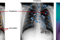 Difference between saccades, fixations, and attention heatmaps in radiologist eye-tracking studies. Image courtesy of the European Journal of Radiology.