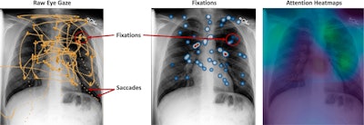 Differences in saccades, fixations, and attention heatmaps in an eye-tracking study of radiologists. Image courtesy of European Journal of Radiology.