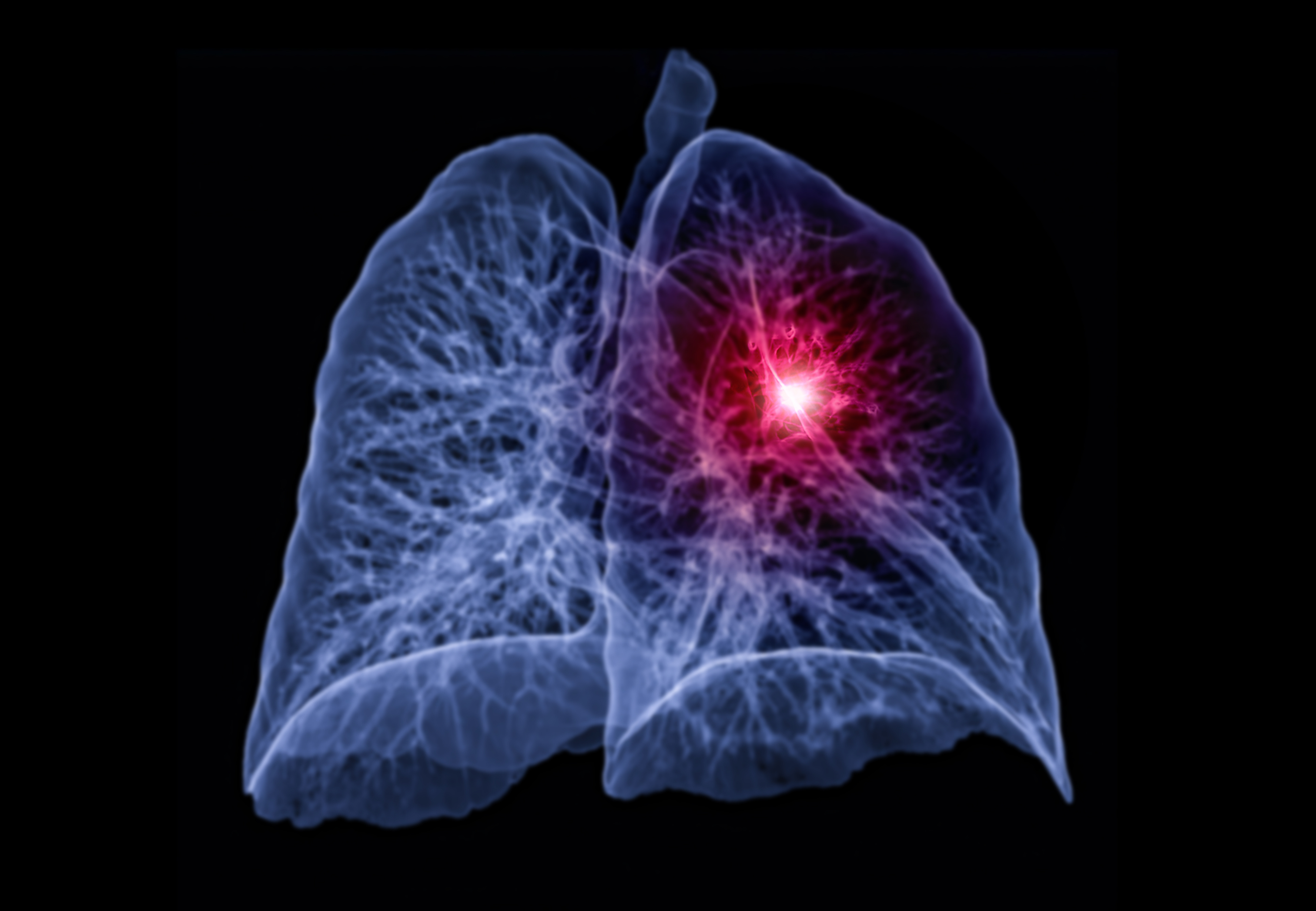 Lung Cancer Ct 3d