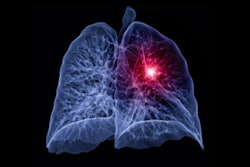 Lung Cancer Ct 3d