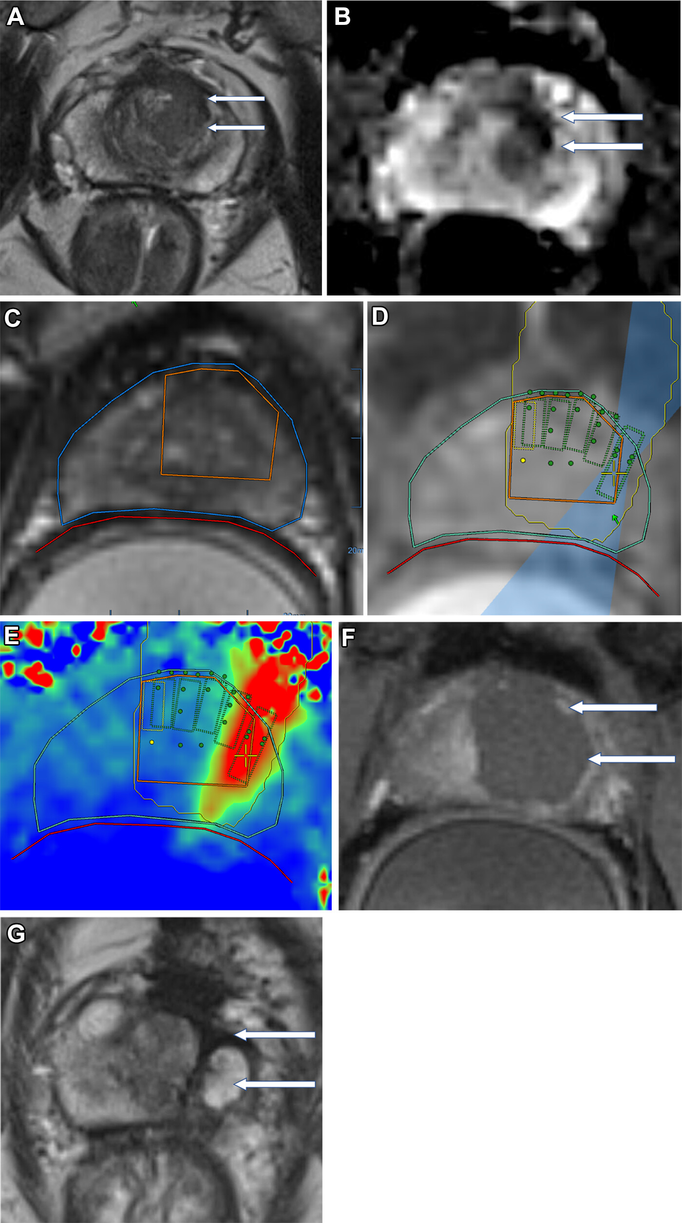 Images depict biopsy-confirmed prostate cancer in a 56-year-old man. (A) Pretreatment axial T2-weighted fast spin-echo MRI scan and (B) apparent diffusion coefficient map acquired with a 3T scanner show the tumor in the left transition zone (arrows). (C) Intraoperative 1.5-T MRI scan shows the contoured rectal wall (red line), prostate margin (blue outline), and region of interest (orange outline). (D) Intraoperative MRI scan shows a focused ultrasound beam path (blue) overlaid on the treatment plan. The rectangular boxes show each sonication spot. (E) Thermal map obtained during treatment shows heat deposition color-coded in red and overlaid on the sonication spot. (F) Axial gadobutrol-enhanced MRI scan obtained immediately after treatment shows the devascularized ablated volume (arrows). (G) Corresponding T2-weighted fast spin-echo 3T MRI scan obtained at 24 months after ablation shows fibrosis and volume loss in the left transition zone (arrows). Findings from a biopsy showed scar tissue, negative for malignancy at the treatment site.