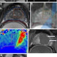 Images depict biopsy-confirmed prostate cancer in a 56-year-old man. (A) Pretreatment axial T2-weighted fast spin-echo MRI scan and (B) apparent diffusion coefficient map acquired with a 3T scanner show the tumor in the left transition zone (arrows). (C) Intraoperative 1.5-T MRI scan shows the contoured rectal wall (red line), prostate margin (blue outline), and region of interest (orange outline). (D) Intraoperative MRI scan shows a focused ultrasound beam path (blue) overlaid on the treatment plan. The rectangular boxes show each sonication spot. (E) Thermal map obtained during treatment shows heat deposition color-coded in red and overlaid on the sonication spot. (F) Axial gadobutrol-enhanced MRI scan obtained immediately after treatment shows the devascularized ablated volume (arrows). (G) Corresponding T2-weighted fast spin-echo 3T MRI scan obtained at 24 months after ablation shows fibrosis and volume loss in the left transition zone (arrows). Findings from a biopsy showed scar tissue, negative for malignancy at the treatment site.