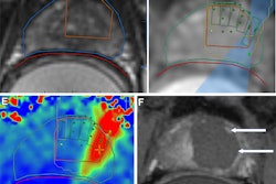 Images depict biopsy-confirmed prostate cancer in a 56-year-old man. (A) Pretreatment axial T2-weighted fast spin-echo MRI scan and (B) apparent diffusion coefficient map acquired with a 3T scanner show the tumor in the left transition zone (arrows). (C) Intraoperative 1.5-T MRI scan shows the contoured rectal wall (red line), prostate margin (blue outline), and region of interest (orange outline). (D) Intraoperative MRI scan shows a focused ultrasound beam path (blue) overlaid on the treatment plan. The rectangular boxes show each sonication spot. (E) Thermal map obtained during treatment shows heat deposition color-coded in red and overlaid on the sonication spot. (F) Axial gadobutrol-enhanced MRI scan obtained immediately after treatment shows the devascularized ablated volume (arrows). (G) Corresponding T2-weighted fast spin-echo 3T MRI scan obtained at 24 months after ablation shows fibrosis and volume loss in the left transition zone (arrows). Findings from a biopsy showed scar tissue, negative for malignancy at the treatment site.