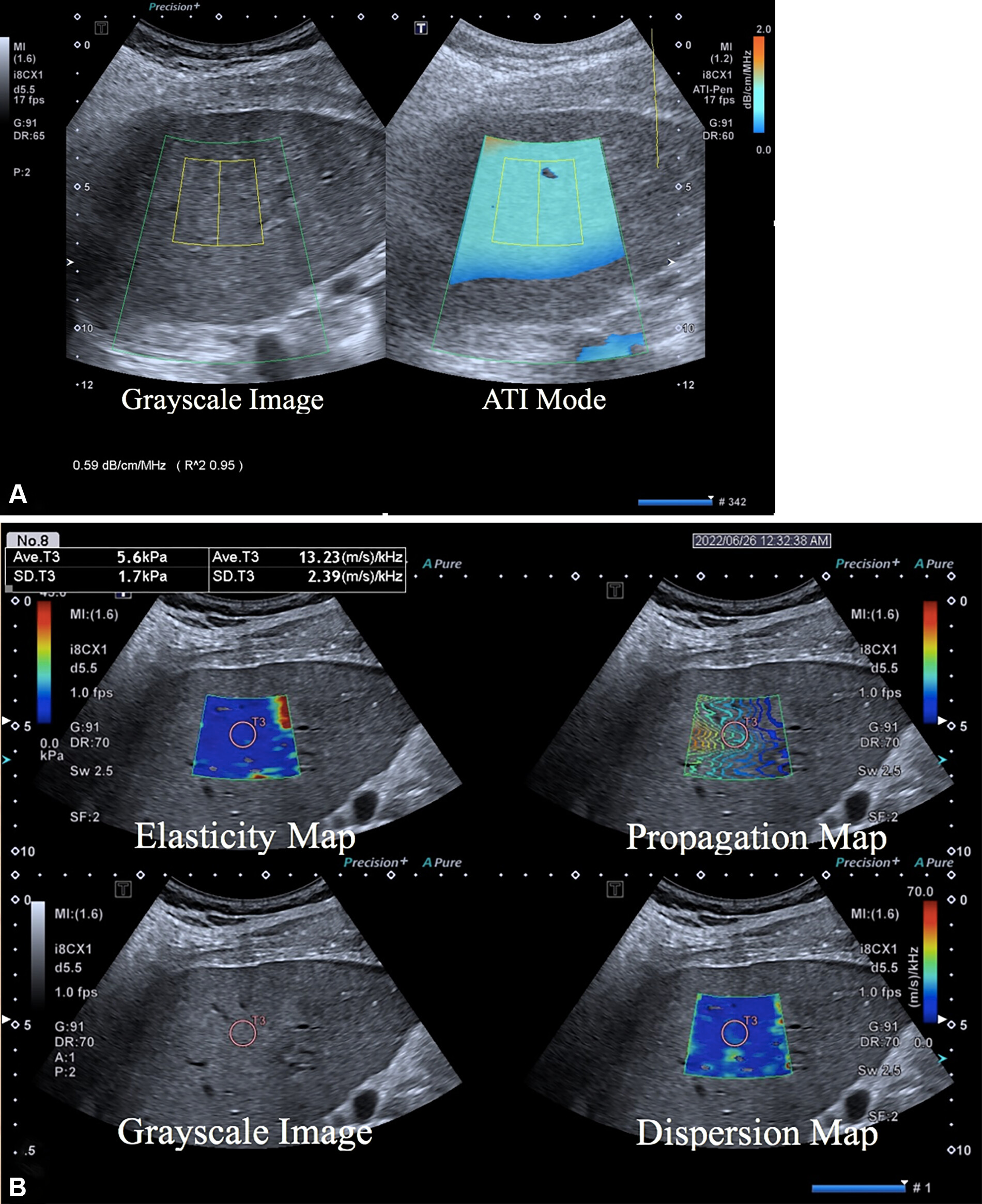Multiparametric ultrasound in a 52-year-old female patient with metabolic dysfunction-associated fatty liver disease (MAFLD) and hepatitis B, whose body mass index was 26.9. (A) Gray-scale image (left) shows the liver parenchyma, and attenuation image (right) shows the right liver lobe acquired from the right intercostal oblique plane, with the degree of attenuation color-coded in the sampling box. Orange indicates a high attenuation coefficient and blue indicates a low attenuation coefficient. The coefficient value (0.59 dB/cm/MHz) and reliability index (R2 = 0.95) are presented in the lower left corner. (B) 2D shear-wave elastography-generated quad-view mode image shows an elasticity map, propagation map, gray-scale image, and dispersion map at the same time. A 1-cm region of interest is placed within the sampling box of each image. Red and blue indicate high and low elasticity and dispersion slope, respectively. Liver stiffness on the elasticity map is 5.6 kPa, and the dispersion slope on the dispersion map is 13.23 (m/sec)/kHz. Image courtesy of the RSNA.
