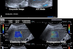 Multiparametric ultrasound in a 52-year-old female patient with metabolic dysfunction-associated fatty liver disease (MAFLD) and hepatitis B, whose body mass index was 26.9. (A) Gray-scale image (left) shows the liver parenchyma, and attenuation image (right) shows the right liver lobe acquired from the right intercostal oblique plane, with the degree of attenuation color-coded in the sampling box. Orange indicates a high attenuation coefficient and blue indicates a low attenuation coefficient. The coefficient value (0.59 dB/cm/MHz) and reliability index (R2 = 0.95) are presented in the lower left corner. (B) 2D shear-wave elastography-generated quad-view mode image shows an elasticity map, propagation map, gray-scale image, and dispersion map at the same time. A 1-cm region of interest is placed within the sampling box of each image. Red and blue indicate high and low elasticity and dispersion slope, respectively. Liver stiffness on the elasticity map is 5.6 kPa, and the dispersion slope on the dispersion map is 13.23 (m/sec)/kHz. Image courtesy of the RSNA.