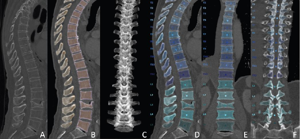 Overview of the automated deep learning-based pipeline. Multidetector CT images show the (A) original data, (B, C) vertebral segmentation, and (D-F) vertebral labeling during preprocessing. Images and caption courtesy of the RSNA.