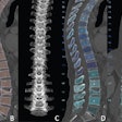 Overview of the automated deep learning-based pipeline. Multidetector CT images show the (A) original data, (B, C) vertebral segmentation, and (D-F) vertebral labeling during preprocessing. Images and caption courtesy of the RSNA.