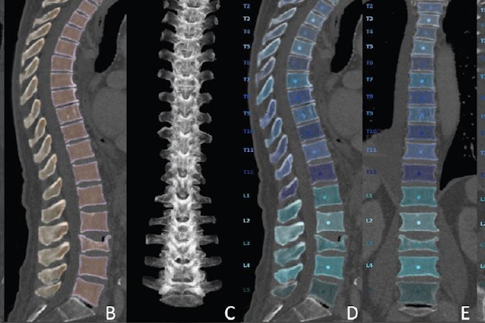 Overview of the automated deep learning-based pipeline. Multidetector CT images show the (A) original data, (B, C) vertebral segmentation, and (D-F) vertebral labeling during preprocessing. Images and caption courtesy of the RSNA.