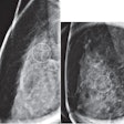 Images taken from a 40-year-old woman with calcifications detected on baseline screening mammography show (A) lateral and (B) craniocaudal magnification views for grouped pleomorphic calcifications in right breast (circles). Stereotac-tic-guided core-needle biopsy yielded radial scar without atypia. Subsequent surgical resection yielded radial scar (i.e., not upstaged). Image courtesy of ARRS.