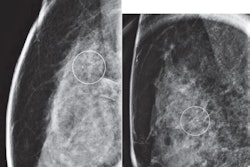 Images taken from a 40-year-old woman with calcifications detected on baseline screening mammography show (A) lateral and (B) craniocaudal magnification views for grouped pleomorphic calcifications in right breast (circles). Stereotac-tic-guided core-needle biopsy yielded radial scar without atypia. Subsequent surgical resection yielded radial scar (i.e., not upstaged). Image courtesy of ARRS.