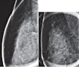 Images taken from a 40-year-old woman with calcifications detected on baseline screening mammography show (A) lateral and (B) craniocaudal magnification views for grouped pleomorphic calcifications in right breast (circles). Stereotac-tic-guided core-needle biopsy yielded radial scar without atypia. Subsequent surgical resection yielded radial scar (i.e., not upstaged). Image courtesy of ARRS.