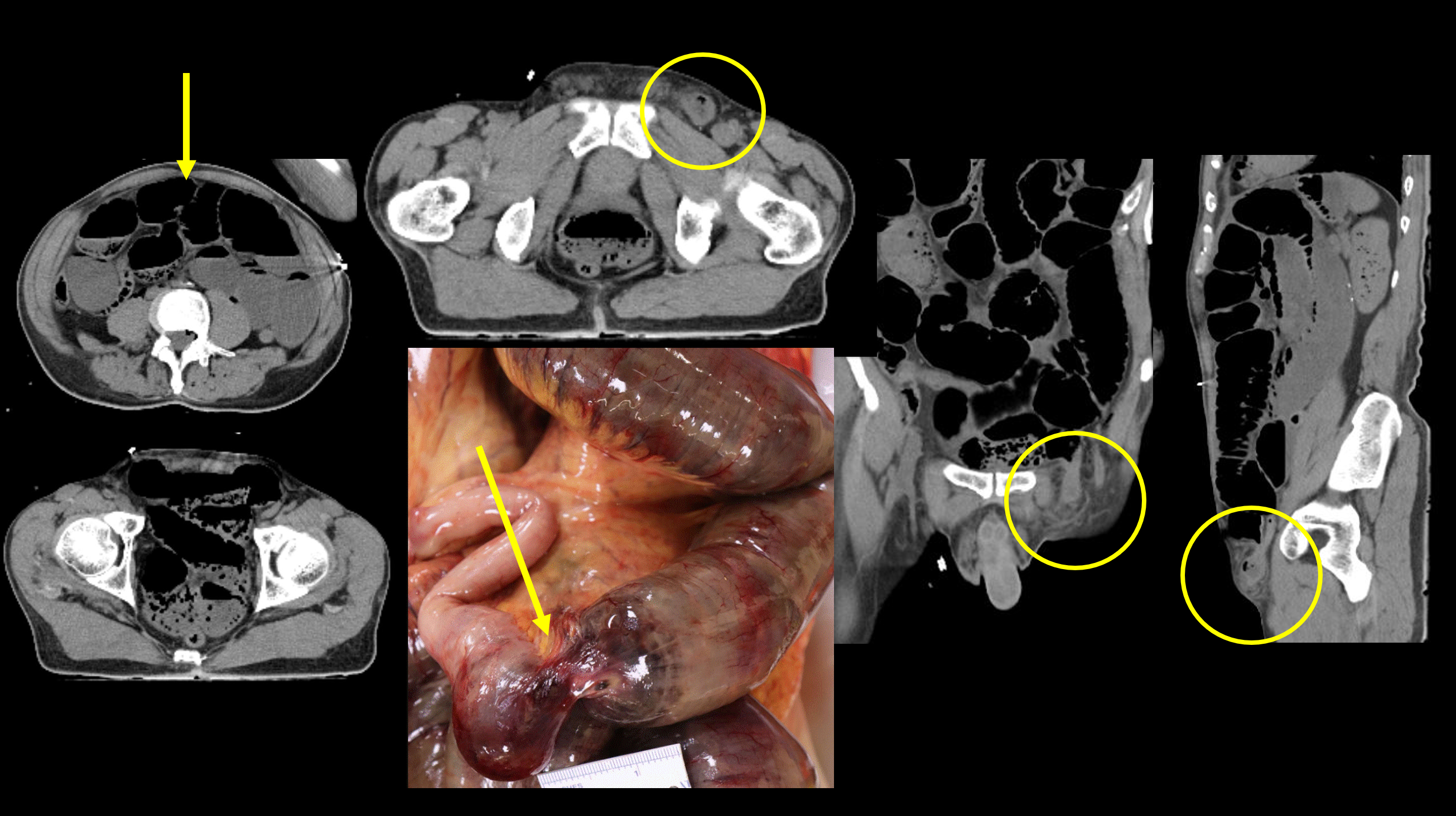 The axial images on soft tissue windows demonstrate the dilated bowel, a common finding in decomposition. The images with the circles denote the incarcerated hernia. The larger photo is the incarcerated and strangulated bowel at autopsy. Images and caption courtesy of Jamie Elifritz, MD.