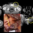 The axial images on soft tissue windows demonstrate the dilated bowel, a common finding in decomposition. The images with the circles denote the incarcerated hernia. The larger photo is the incarcerated and strangulated bowel at autopsy. Images and caption courtesy of Jamie Elifritz, MD.