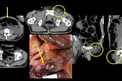 The axial images on soft tissue windows demonstrate the dilated bowel, a common finding in decomposition. The images with the circles denote the incarcerated hernia. The larger photo is the incarcerated and strangulated bowel at autopsy. Images and caption courtesy of Jamie Elifritz, MD.