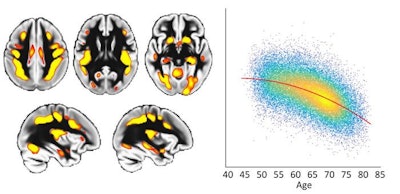 MRI reveals effects of risk factors on vulnerable brain regions ...