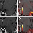 T1-weighted postgadolinium MR images (A and C) and F-18 FET-PET/MR images (B and D) centered at pituitary before (A and B) and after (C and D) transsphenoidal surgery. This patient with Cushing disease showed clear focal uptake (B) but no clear lesion on previously obtained and accompanying MRI (A). Postoperative tissue analysis did confirm resection of small pituitary adenoma/PitNET, and postoperative F-18 FET-PET showed no residual uptake (D). Image courtesy of the Journal of Nuclear Medicine.