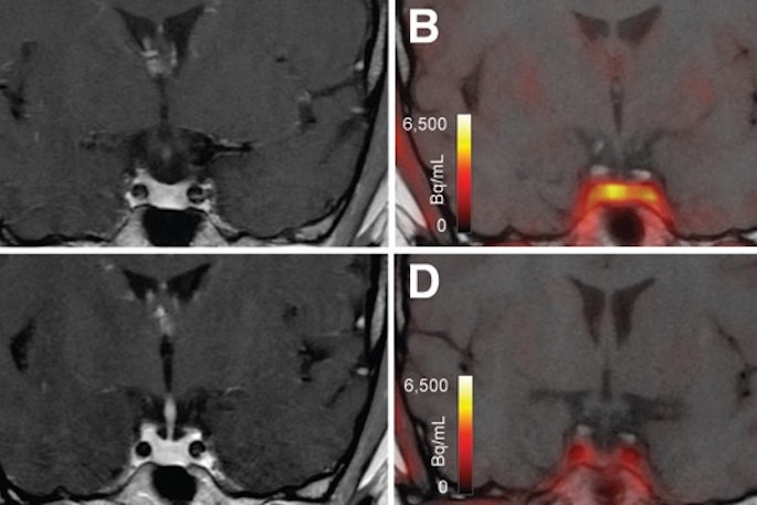 T1-weighted postgadolinium MR images (A and C) and F-18 FET-PET/MR images (B and D) centered at pituitary before (A and B) and after (C and D) transsphenoidal surgery. This patient with Cushing disease showed clear focal uptake (B) but no clear lesion on previously obtained and accompanying MRI (A). Postoperative tissue analysis did confirm resection of small pituitary adenoma/PitNET, and postoperative F-18 FET-PET showed no residual uptake (D). Image courtesy of the Journal of Nuclear Medicine.