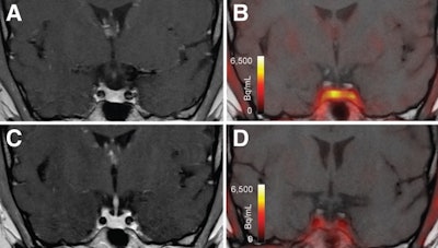 T1-weighted postgadolinium MR images (A and C) and F-18 FET-PET/MR images (B and D) centered at pituitary before (A and B) and after (C and D) transsphenoidal surgery. This patient with Cushing disease showed clear focal uptake (B) but no clear lesion on previously obtained and accompanying MRI (A). Postoperative tissue analysis did confirm resection of small pituitary adenoma/PitNET, and postoperative F-18 FET-PET showed no residual uptake (D). Image courtesy of the Journal of Nuclear Medicine.