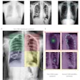 (a) Raw example of a dynamic digital radiograph. (b) Contrast equalization using contrast-limited adaptive equalization shows improved anatomical visualization. (c) Training data is generated through manually labeling using SLEAP’s graphical user interface. (d-e) Neural network detection schematic. For each quadrant a series of two networks were used. The first identifies the quadrant center, the second using input of the first, then identifies individual anatomical landmarks within a quadrant. (d) Four neural networks were trained, each with the objective of identifying a chest quadrant centroid. The four separate quadrants are visualized as colored boxes (right upper quadrant, green; right lower quadrant, blue; left upper quadrant, red; left lower quadrant, yellow). (e) Serial centroid then anatomical identification. Two quadrant examples showing confidence maps of trained neural networks identifying quadrant centroids (left) and then anatomical confidence maps (right). Image and caption courtesy of Chest Pulmonary.