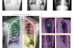 (a) Raw example of a dynamic digital radiograph. (b) Contrast equalization using contrast-limited adaptive equalization shows improved anatomical visualization. (c) Training data is generated through manually labeling using SLEAP’s graphical user interface. (d-e) Neural network detection schematic. For each quadrant a series of two networks were used. The first identifies the quadrant center, the second using input of the first, then identifies individual anatomical landmarks within a quadrant. (d) Four neural networks were trained, each with the objective of identifying a chest quadrant centroid. The four separate quadrants are visualized as colored boxes (right upper quadrant, green; right lower quadrant, blue; left upper quadrant, red; left lower quadrant, yellow). (e) Serial centroid then anatomical identification. Two quadrant examples showing confidence maps of trained neural networks identifying quadrant centroids (left) and then anatomical confidence maps (right). Image and caption courtesy of Chest Pulmonary.