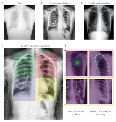 (a) Raw example of a dynamic digital radiograph. (b) Contrast equalization using contrast-limited adaptive equalization shows improved anatomical visualization. (c) Training data is generated through manually labeling using SLEAP’s graphical user interface. (d-e) Neural network detection schematic. For each quadrant a series of two networks were used. The first identifies the quadrant center, the second using input of the first, then identifies individual anatomical landmarks within a quadrant. (d) Four neural networks were trained, each with the objective of identifying a chest quadrant centroid. The four separate quadrants are visualized as colored boxes (right upper quadrant, green; right lower quadrant, blue; left upper quadrant, red; left lower quadrant, yellow). (e) Serial centroid then anatomical identification. Two quadrant examples showing confidence maps of trained neural networks identifying quadrant centroids (left) and then anatomical confidence maps (right). Image and caption courtesy of Chest Pulmonary.
