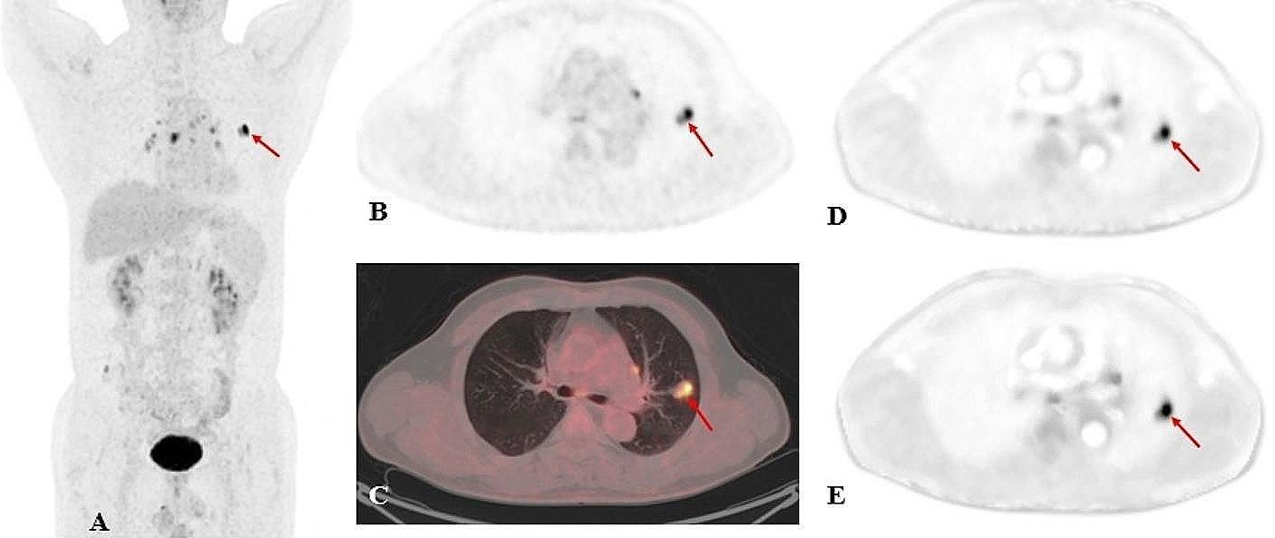 A 60-year-old male patient with clinical suspicion of lung cancer. PET/CT scan showed FDG-avid pulmonary nodules in the upper lobe of the left lung (red arrow), with a size of 2.2 &times; 1.3 cm, SUVmax of 12.2, Ki-65 min of 0.016 ml/g/min, and Ki-30 min of 0.014 ml/g/min. Surgical pathology confirmed a granulomatous lesion. In addition, PET/CT scan showed many FDG-avid lung nodules in the mediastinum. (A, static PET maximum intensity projection; B, static PET SUV image; C, static PET/CT fusion image; D, dynamic PET Ki-65 min image; E, dynamic PET Ki-30 min image). Image courtesy of EJNMMI Physics.