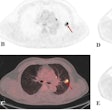 A 60-year-old male patient with clinical suspicion of lung cancer. PET/CT scan showed FDG-avid pulmonary nodules in the upper lobe of the left lung (red arrow), with a size of 2.2 × 1.3 cm, SUVmax of 12.2, Ki-65 min of 0.016 ml/g/min, and Ki-30 min of 0.014 ml/g/min. Surgical pathology confirmed a granulomatous lesion. In addition, PET/CT scan showed many FDG-avid lung nodules in the mediastinum. (A, static PET maximum intensity projection; B, static PET SUV image; C, static PET/CT fusion image; D, dynamic PET Ki-65 min image; E, dynamic PET Ki-30 min image). Image courtesy of EJNMMI Physics.
