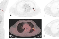 A 60-year-old male patient with clinical suspicion of lung cancer. PET/CT scan showed FDG-avid pulmonary nodules in the upper lobe of the left lung (red arrow), with a size of 2.2 × 1.3 cm, SUVmax of 12.2, Ki-65 min of 0.016 ml/g/min, and Ki-30 min of 0.014 ml/g/min. Surgical pathology confirmed a granulomatous lesion. In addition, PET/CT scan showed many FDG-avid lung nodules in the mediastinum. (A, static PET maximum intensity projection; B, static PET SUV image; C, static PET/CT fusion image; D, dynamic PET Ki-65 min image; E, dynamic PET Ki-30 min image). Image courtesy of EJNMMI Physics.