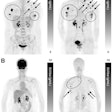 Maximum-intensity projection F-18 FDG-PET (left) and Ga-68 FAPI-PET (right) images of synchronous ILC. (A) A 42-year-old patient with multicentric primary lesions (encircled), regional (solid arrows), and distant inferior jugular lymph node (dashed arrows) seen on F-18 FDG-PET and subsequently confirmed on Ga-68 FAPI-PET, which also revealed additional malignant foci aligned with MRI. Some lesions exhibited high activity retention on Ga-68 FAPI-PET. (B) A 53-year-old patient showing no significant uptake on F-18 FDG-PET but synchronous bilateral lesions (arrows) on Ga-68 FAPI-PET, which also identified pathologic lymph nodes (encircled), resulting in upstaging. Image courtesy of the Journal of Nuclear Medicine.