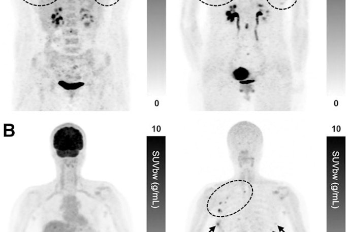 Maximum-intensity projection F-18 FDG-PET (left) and Ga-68 FAPI-PET (right) images of synchronous ILC. (A) A 42-year-old patient with multicentric primary lesions (encircled), regional (solid arrows), and distant inferior jugular lymph node (dashed arrows) seen on F-18 FDG-PET and subsequently confirmed on Ga-68 FAPI-PET, which also revealed additional malignant foci aligned with MRI. Some lesions exhibited high activity retention on Ga-68 FAPI-PET. (B) A 53-year-old patient showing no significant uptake on F-18 FDG-PET but synchronous bilateral lesions (arrows) on Ga-68 FAPI-PET, which also identified pathologic lymph nodes (encircled), resulting in upstaging. Image courtesy of the Journal of Nuclear Medicine.