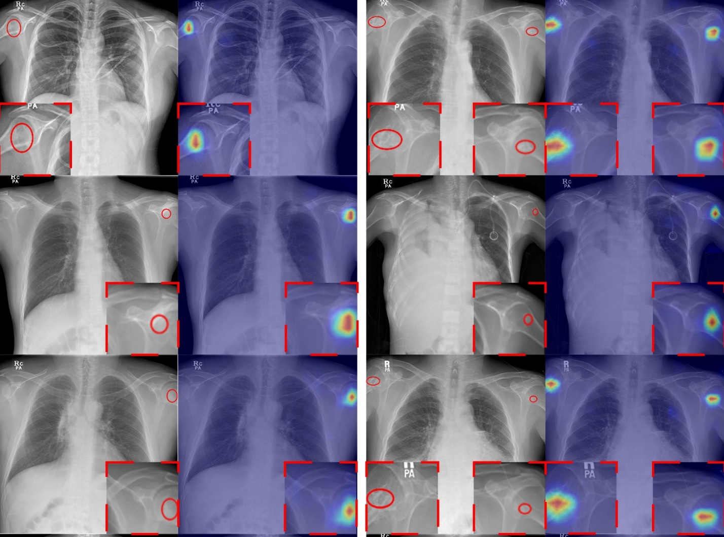 The tumor localization/visualization results obtained by the proposed AI algorithm. Original chest x-ray images with a lesion (red circle = radiologists&rsquo; annotation of the lesion location) and AI's lesion localization result. These examples demonstrate that the proposed technique can successfully detect humeral tumors. Image and caption courtesy of Radiology: Artificial Intelligence.